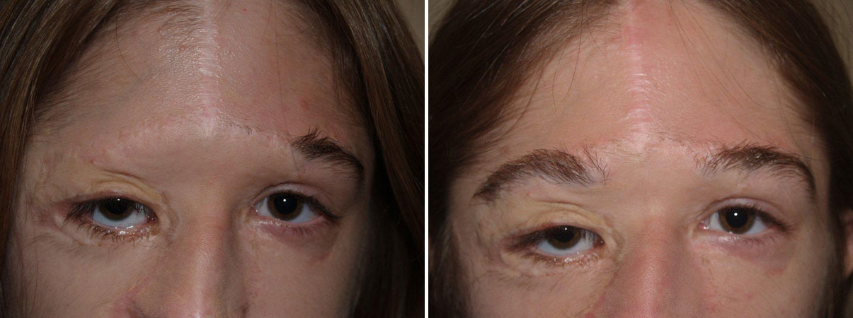 Eyebrow Transplantation Photos Page 11 Of 14 Eyebrow Transplant Miami