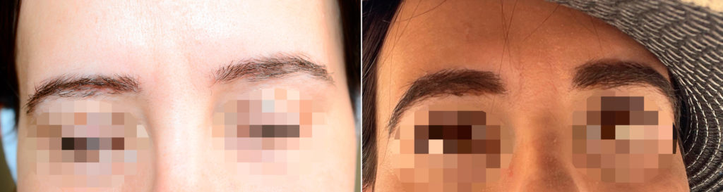 Eyebrow Transplantation Photos Eyebrow Transplant Miami