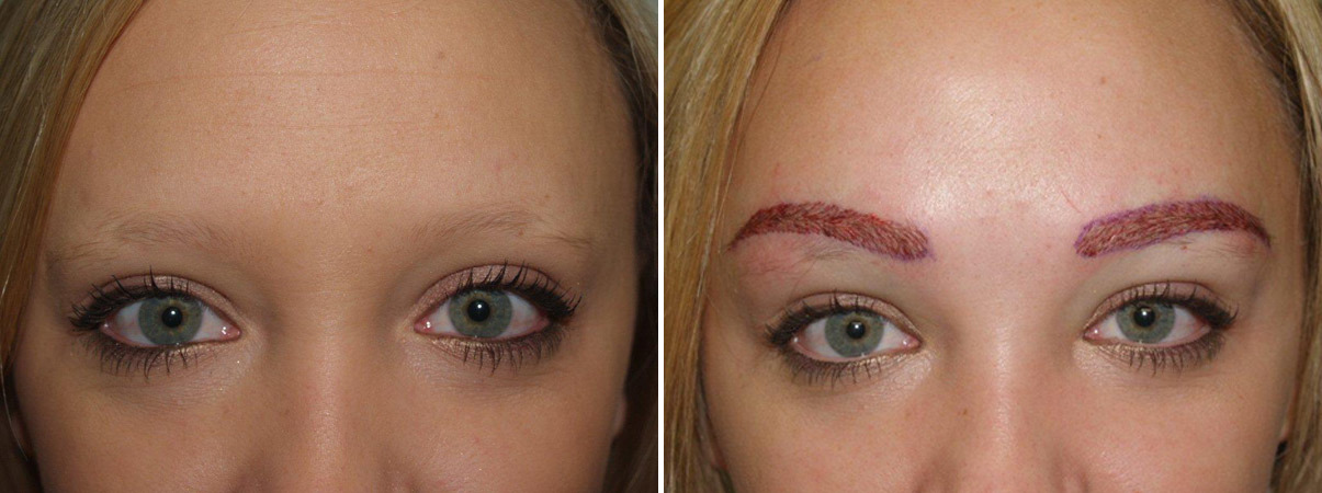Eyebrow Transplantation Photos Miami Fl New York Ny Patient 16487